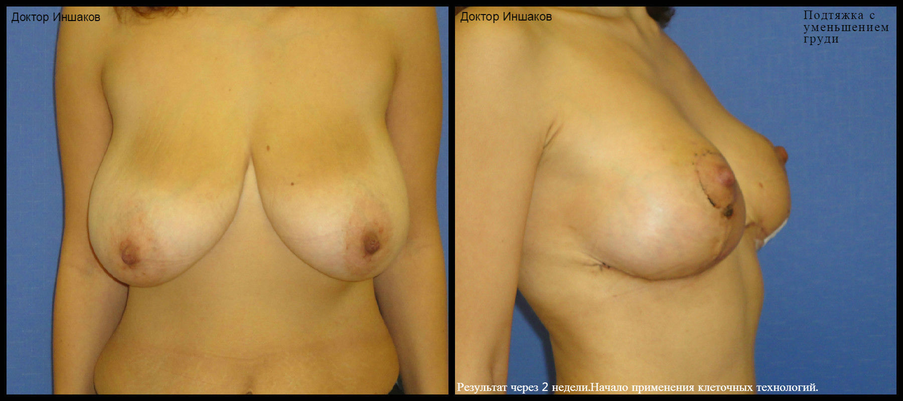 уменьшение размера груди операцией фото 30