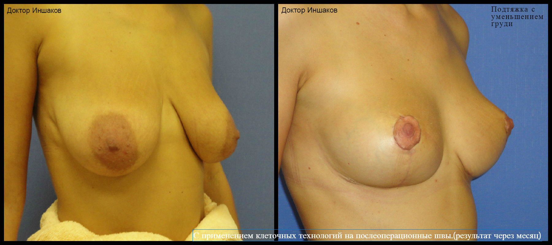 уменьшение груди у женщин в домашних условиях фото 56